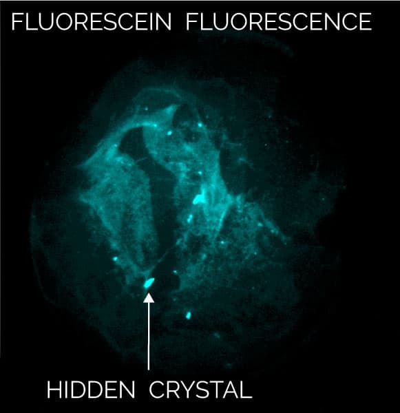 protein crystals in precipitate - multi-flruorescence imaging